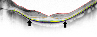 Side view of a retina as captured by SD-OCT