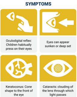 SYMPTOMS Oculodigital reflex: Children habitually press on their eyes Eyes can appear sunken or deep set Keratoconus: Cone shape to the front of the eye Cataracts: clouding of the lens through which light passes.